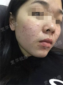 听说长痘后很多人都是这么做的