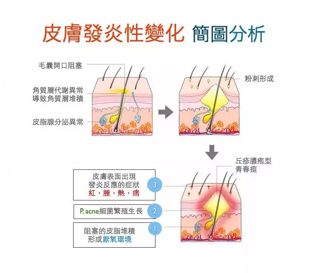 痘痘的形成