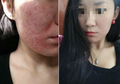 长痘多年 只用一招就恢复可能吗？