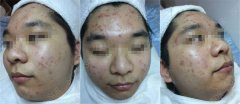 因为痘痘渐渐被女生隔离了