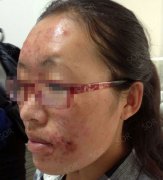 终于，我可以用光滑诠释我没痘的皮肤了