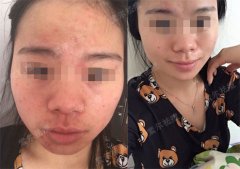 我与青春痘之间的那些事！
