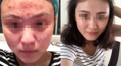 痘痘治好了，总结下自己亲身经历