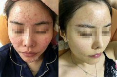 青春痘差点毁了我工作 幸好我找到了索尔