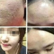 脸上突然长了好多粉刺该怎么办