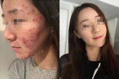 痘痘没了 面试也有信心