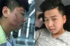 对付满脸痘痘 还少了一点