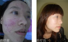 痘友致谢SOR 送来锦旗！