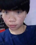 一个吃货的辛酸祛痘史